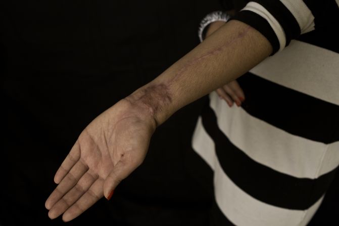 Scars on her left arm show where doctors took tissue that was then transplanted onto her face. Her emotional scars are also healing, and she's learning to trust in new ways.