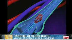 early gupta blood clot dangers_00010714