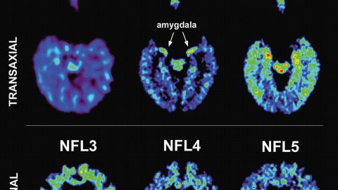 CTE is a degenerative brain disease linked to repeated trauma. A brain with CTE contains clumps of protein called tau. 