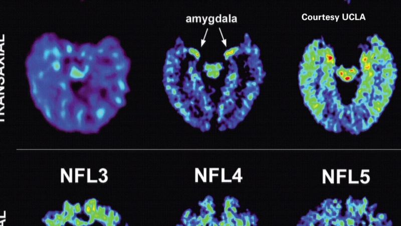 Scan May Detect Signs Of NFL Players’ Brain Disease | CNN