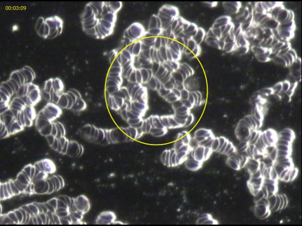 This image, provided by Australian naturopathic physician Hamish Everard, shows what blood looks like before going on a gluten-free diet. The cells are clumped closely together.