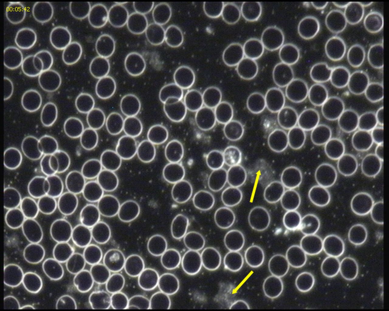 This image, taken after the subject went on a gluten-free diet, shows the blood cells are able to flow more freely -- allowing better transportation of oxygen around the body.