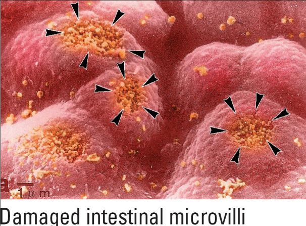 People who are gluten intolerant suffer damage to their intestinal microvilli. "We have seen a definite link in gluten intolerant patients as far as a decrease in beneficial stomach bacteria, an increase in acidity and a decrease in both gastric digestive enzymes and pancreatic enzymes," says Everard.