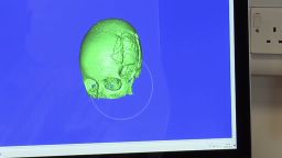 malala 3D imaging skull hospital _00001430.jpg
