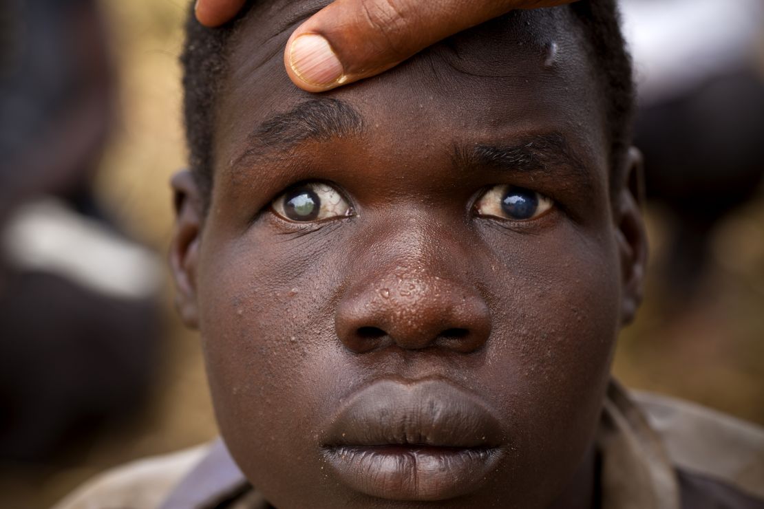 Okello Noel, 18 years old,  lives in Kibega Villiage, in Pader District, Uganda. Noel lost his sight in 2007. The Carter Center's River Blindness Program now assists the national ministry of health in providing mass drug distribution in Noel's community so that  future generations will not suffer from impaired vision caused by river blindness. 