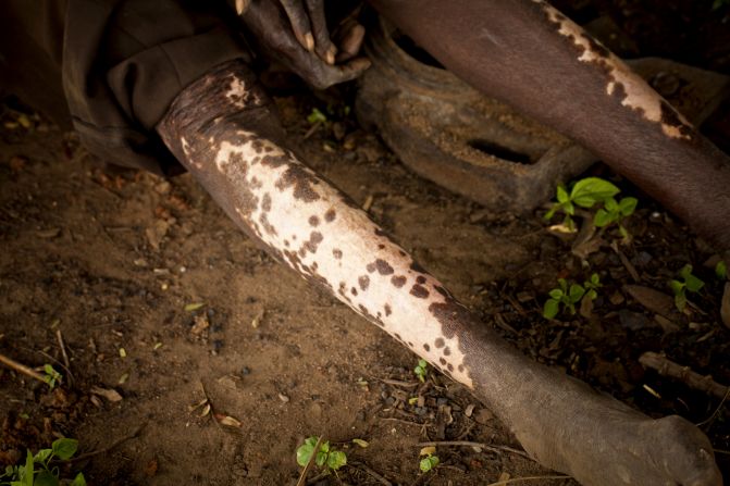 Leopard skin is one symptom of river blindness. The more infected black fly bites a person receives, the more severe the illness becomes. 