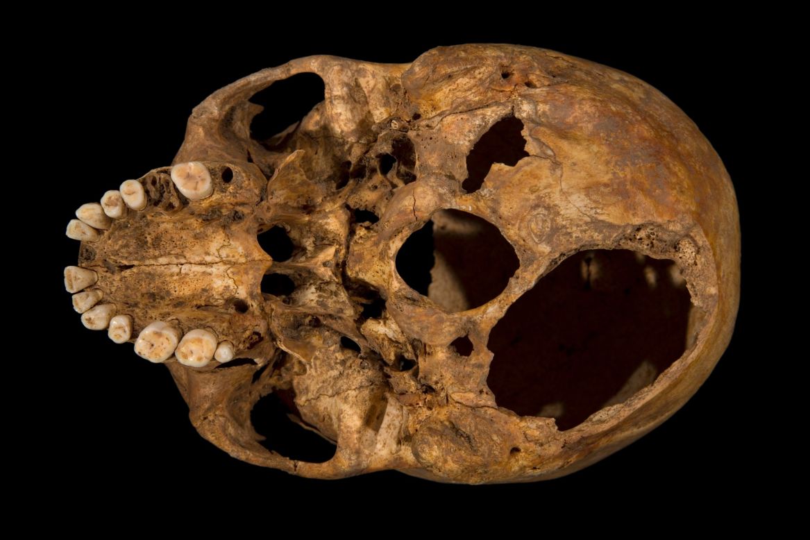 Scientists at the University of Leicester say their examination of the skeleton shows Richard met a violent death: They found evidence of 11 wounds -- nine to the head and two to the body -- that they believe were inflicted at or around the time of death. Here, the base of the skull shows one of the potentially fatal injuries. This shows clearly how a section of the skull had been sliced off.