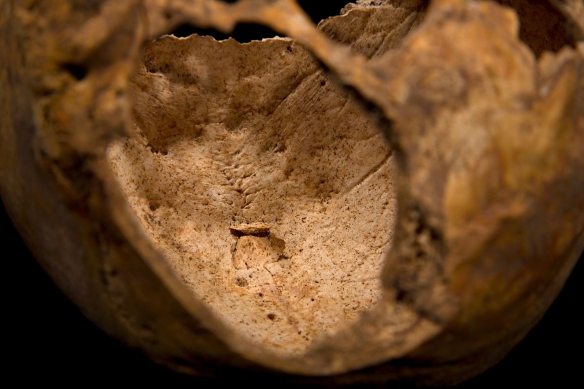Two flaps of bone, related to the penetrating injury to the top of the head, can clearly be seen on the interior of the skull. 