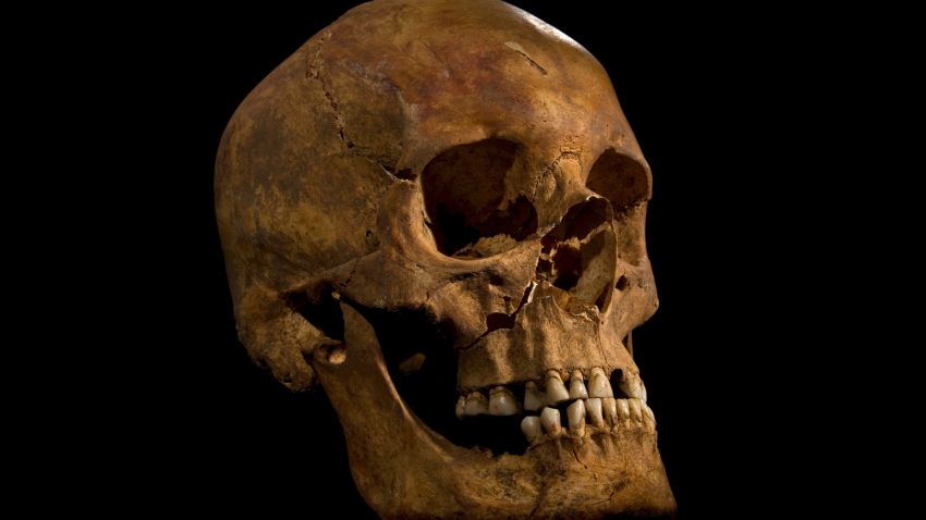 The skull showing the wound to the right cheek.