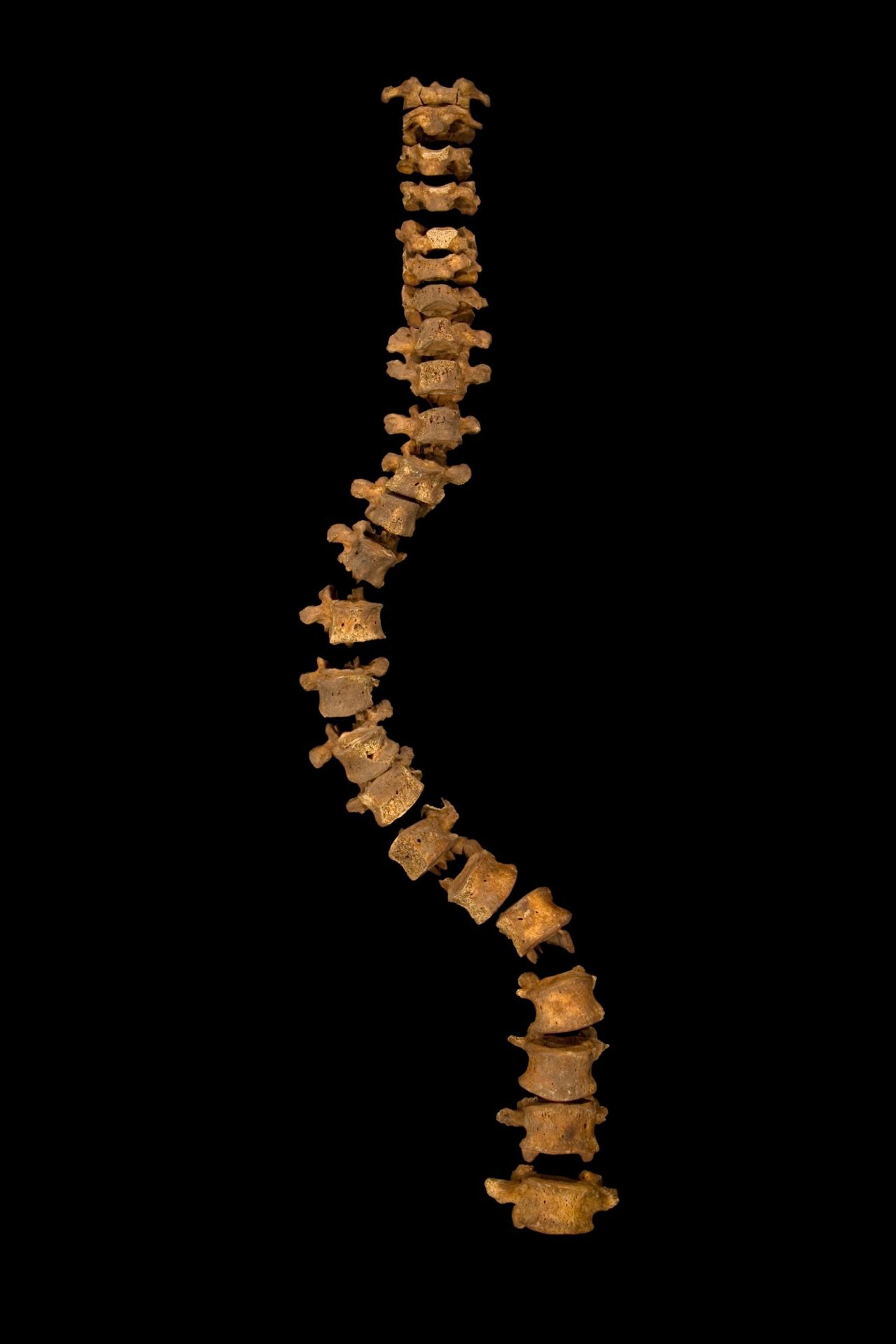 As the skeleton was being excavated, a notable curve in the spine could be seen. (The width of the curve is correct, but the gaps between vertebrae have been increased to prevent damage from them touching one another.)