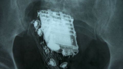 A mobile phone and a hands free kit are seen in an X-ray of a Sri Lankan prisoner. 