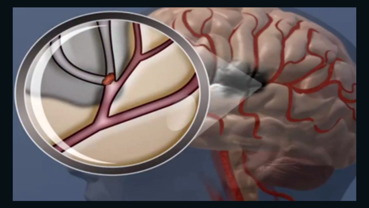 In an ischemic stroke, a blockage in a blood vessel stops essential oxygen and nutrients from reaching the brain. 