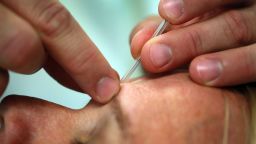 Acupuncture's potential role in treating allergies should be investigated further, according to authors of a new study.