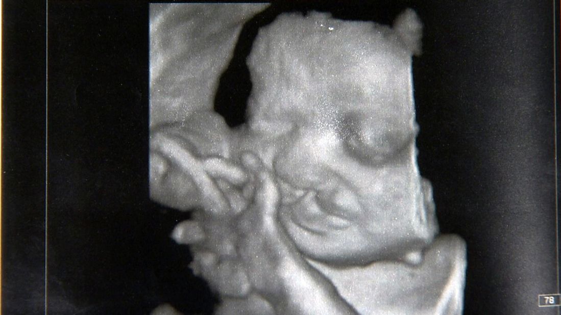 Ultrasounds halfway through Kelley's pregnancy showed the baby girl growing inside her had severe heart defects, a brain abnormality, and other medical problems. 