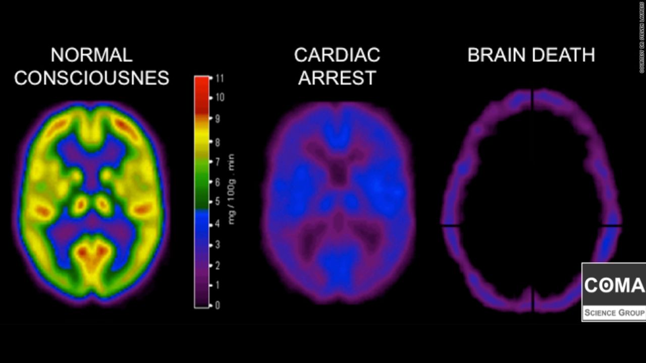 Scans compare neurological activity in a brain that is healthy, one that is comatose and another that is dead