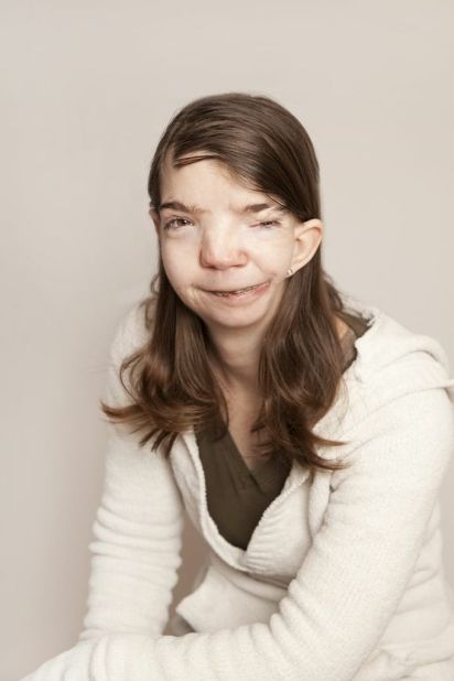 Penny Loker, 31, was born with two birth defects -- hemifacial microsomia and Goldenhar Syndrome -- that left her with a disfigured face. 