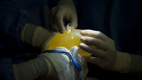 Surgeons remove a broken PIP breast implant in Caracas, Venezuela, on January 25, 2012.