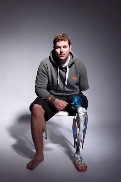 ALP now creates prostheses for a wide range of clients, including British ex-serviceman Ryan Seary, who lost his left hand and lower left leg in Helmand Province, Afghanistan. He now boasts a striking custom limb, featuring anatomically correct muscles and bones.