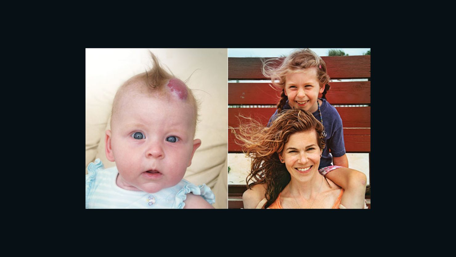 Chloe as a toddler with her birthmark, left, and the author and her daughter now, right.