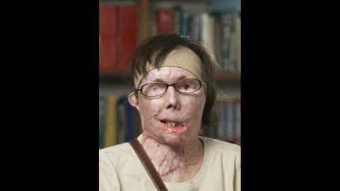Tarleton appears in July 2011 before her face transplant surgery. She is totally blind in one eye and partially blind in the other.