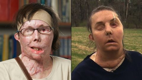 After Carmen Tarleton's estranged husband doused her with industrial-strength lye, doctors saved her life with a medically induced coma and more than 50 surgeries. She received a full facial transplant in February.