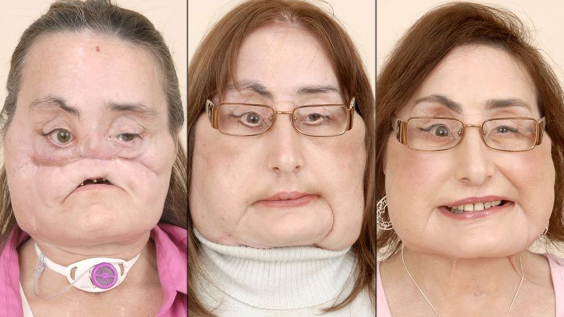 More than two years after undergoing a landmark, near-total face transplant at the Cleveland Clinic, Connie Culp said she was happy with the transformation.
