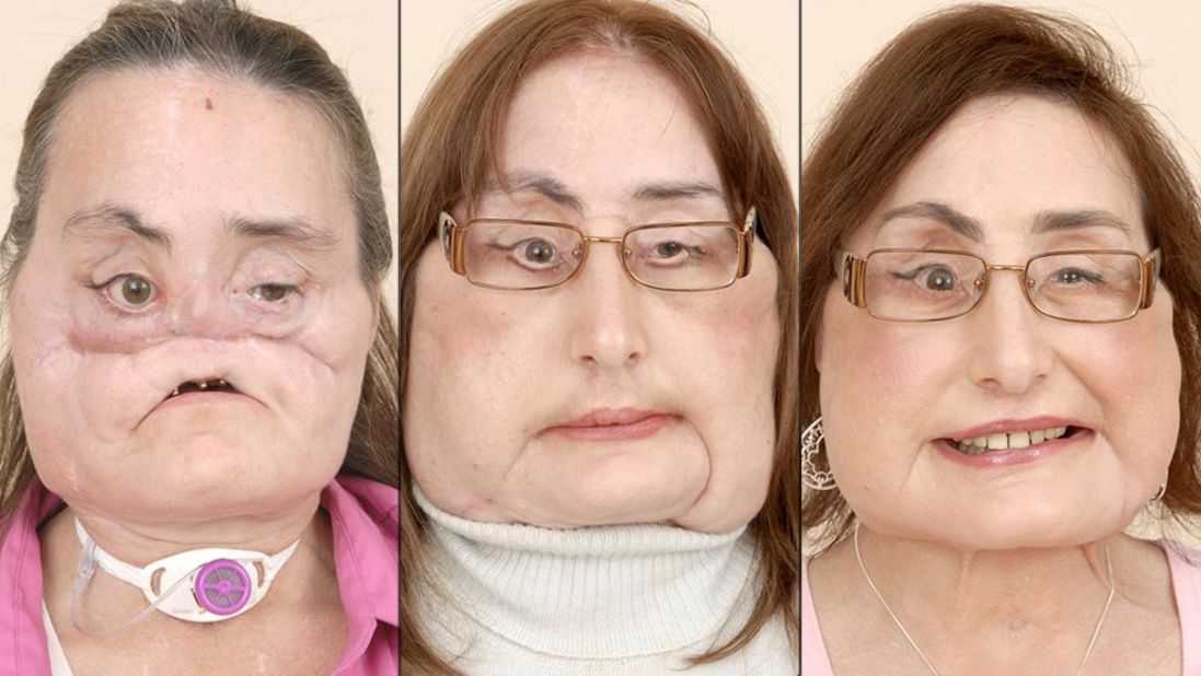 The first partial face transplant was done in Amiens, France, in 2005. Five years later, <a href="http://www.cnn.com/2010/HEALTH/04/24/spain.face.transplant/index.html">doctors in Spain</a> completed the world's first full-face transplant on a man who severely damaged his face in an accident -- giving him a new nose, lips, teeth and cheekbones during 24 hours of surgery. The first full-face transplant done in the United States was performed on <a href="http://www.cnn.com/2013/05/02/health/face-transplant-patients">Connie Culp</a>, seen here, in 2008. 