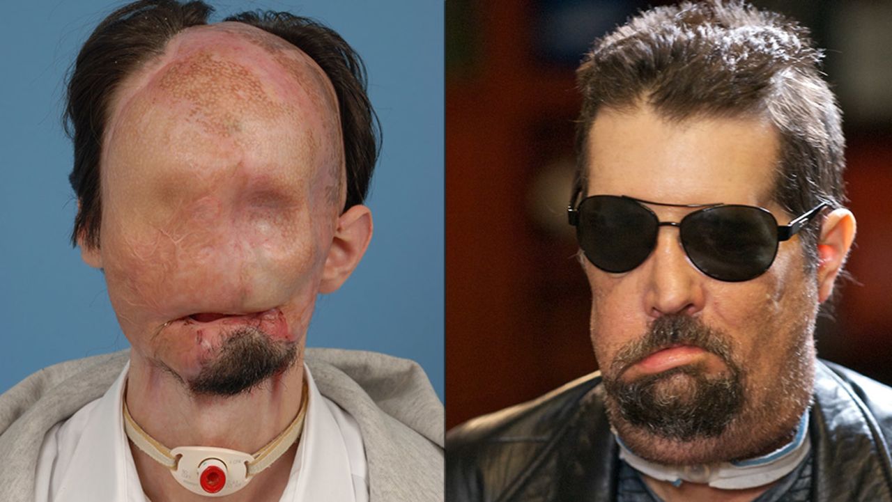 Dallas Wiens lost almost his entire face from burns in 2008. He underwent the first full facial transplant in the country in 2011.