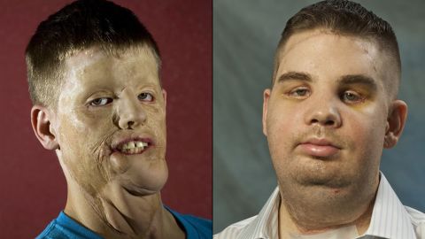 Mitch Hunter suffered significant injury after a car accident in 2001. After a face transplant, he now has near-normal sensation, and his speech has continued to improve.