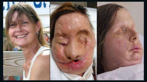 Charla Nash before, during and after her face transplant.