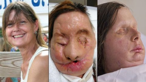 Charla Nash was mauled by a friend's chimpanzee and underwent a face transplant in May 2011 at Brigham and Women's Hospital in Boston.