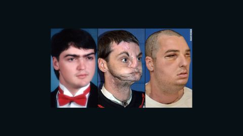 Richard Norris: left, in high school in 1993; center, after a gunshot injury; right, after face transplant surgery.