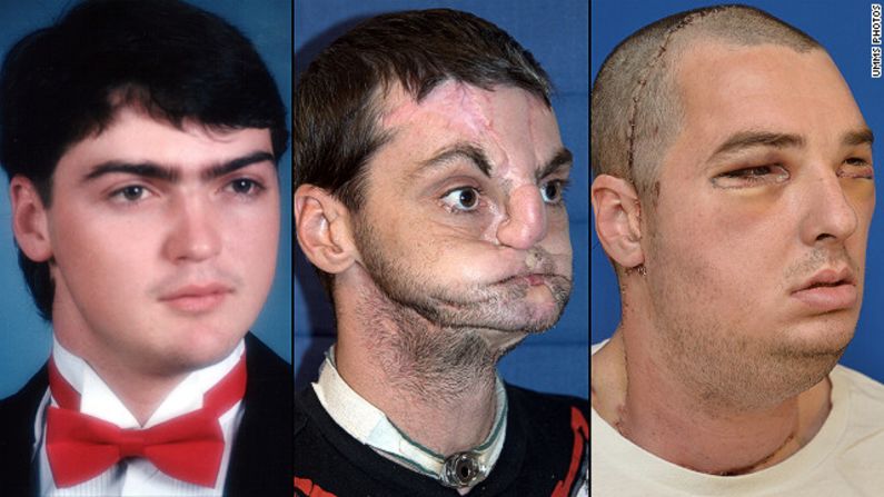 Richard Norris had a gun accident in 1997, and wore a surgical mask for 15 years to hide his face from the world. He is shown, left, in high school in 1993; center, after the gunshot injury; right, after face transplant surgery.