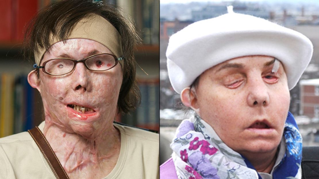 Carmen Tarleton as she appeared before (left) and after the face transplant.