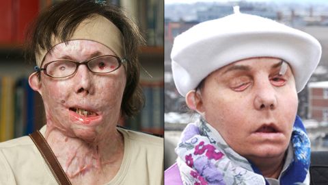 Carmen Blandin Tarleton became disfigured after her estranged husband doused her with industrial-strength lye. After a face transplant, she says she's "thrilled" and has a new goal: to kiss her boyfriend.