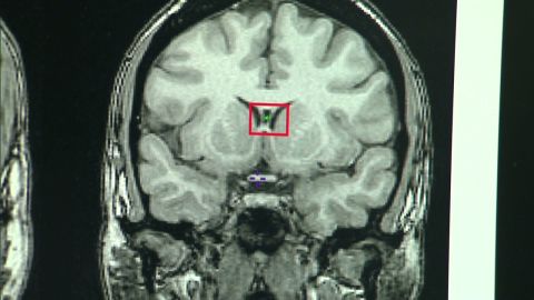 Brain scans have become increasingly sensitive over the years, and data scientists have improved methods of interpreting all of that data.