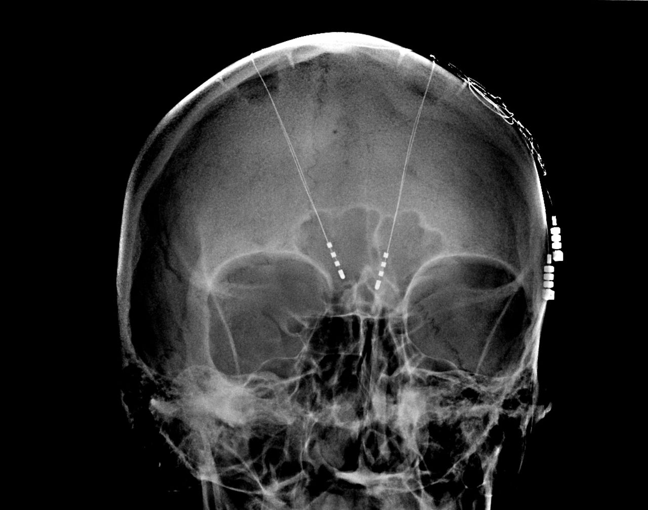 Deep brain stimulation using electrodes and implants for epilepsy and other conditions has helped to pave the way for social acceptance of invasive brain procedures.
