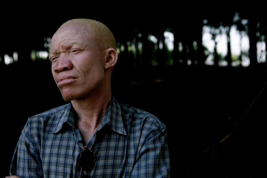 In a country where most albinos live their life in the shadows, Torner has stepped out to debunk the misconceptions in the hope of creating a more inclusive society.
