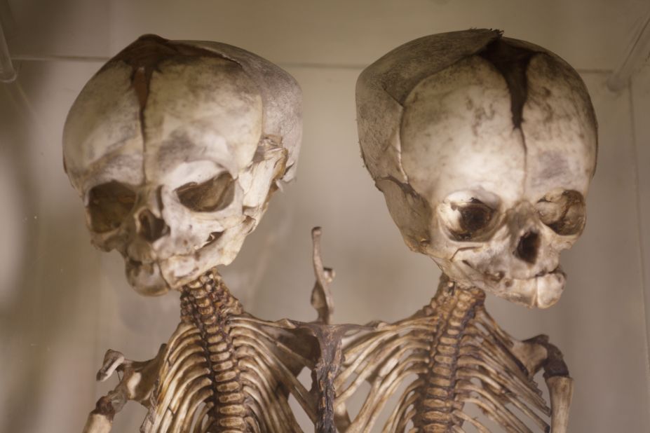 This London museum houses nearly 5,000 medical oddities, including random objects pulled from human bodies over the past 150 years -- toothbrush in the esophagus, anyone?