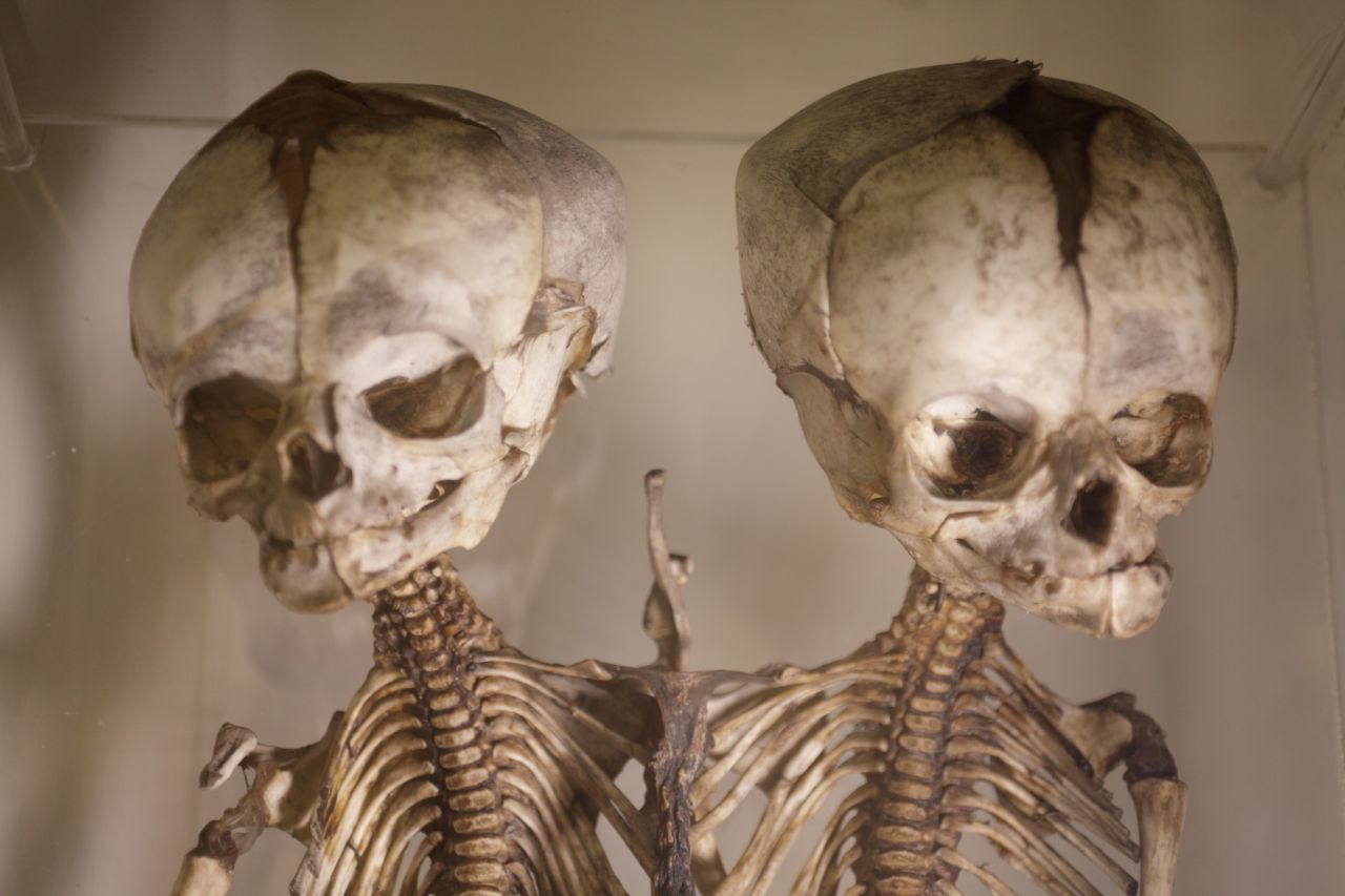 La colección del Museo de Patología de Bart en Gran Bretaña conserva cerca de 5.000 especímenes considerados rarezas médicas.