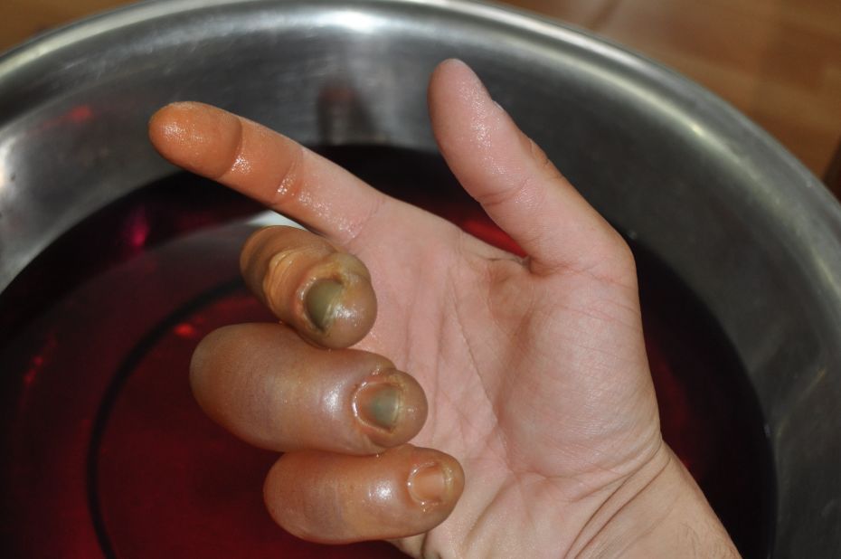 Ben Yehuda's hand after frostbite set in.