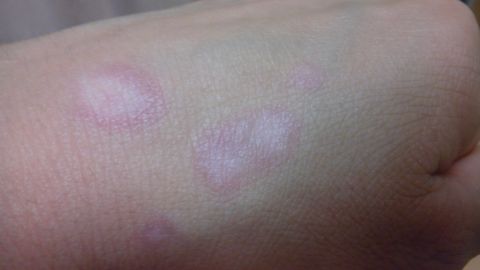 Image supplied by Kanebo shows examples of the white blotches that have appeared on victims' skin.