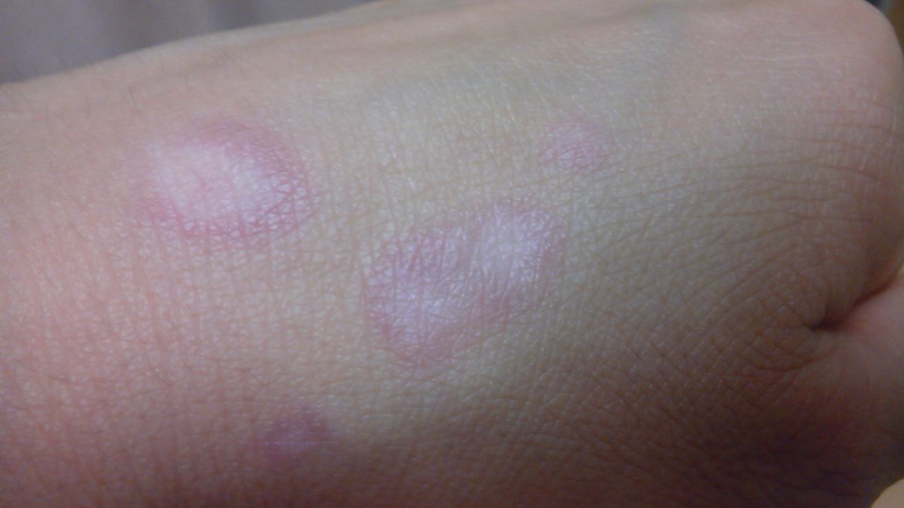 Image supplied by Kanebo shows examples of the white blotches that have appeared on victims' skin.