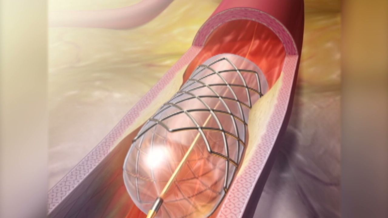 What is a stent? | CNN