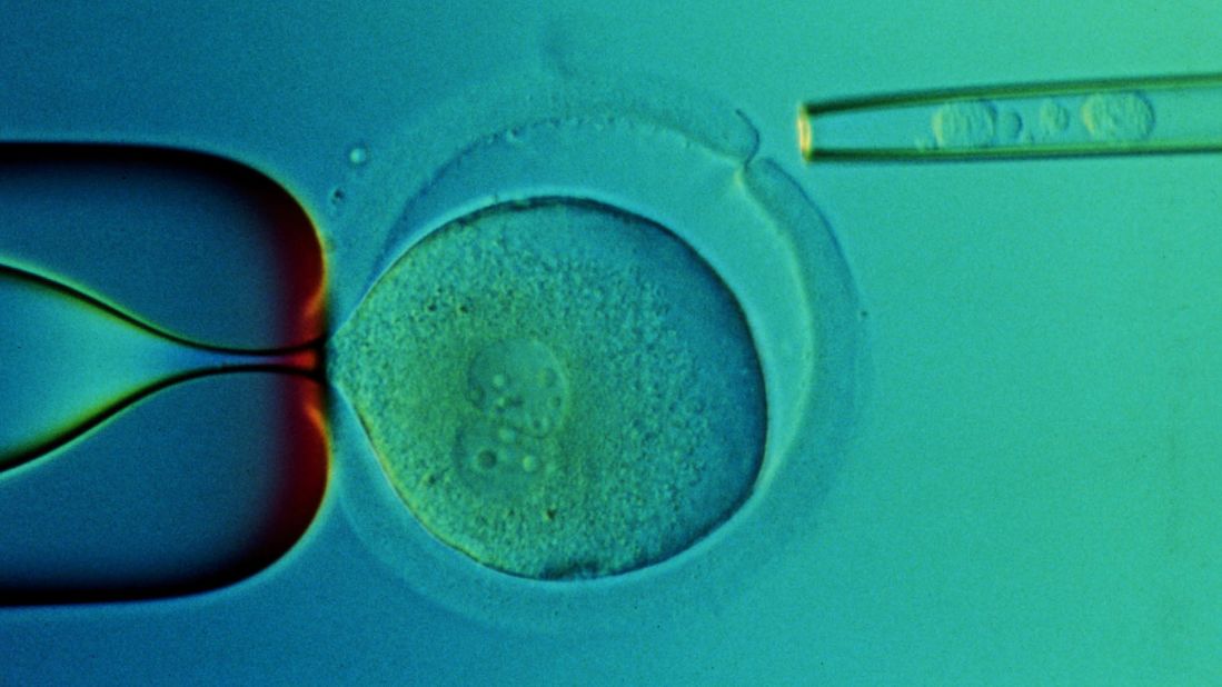 A closeup of a microscope slide taken in 2000 at the Reproductive Genetics Institute's Chicago laboratory shows transplanted stem cells taken from the umbilical cord blood of a baby named Adam Nash. Adam's sister Molly has a genetic disease called Fanconi anemia. Their parents wanted to have a child who could be a stem cell donor for Molly. Using in vitro fertilization, doctors created embryos and then tested them for the genetic disease. They chose one that did not have the disorder, which grew into baby Adam. Molly received a stem cell transplant from stem cells from Adam's umbilical cord. Both children are alive today.