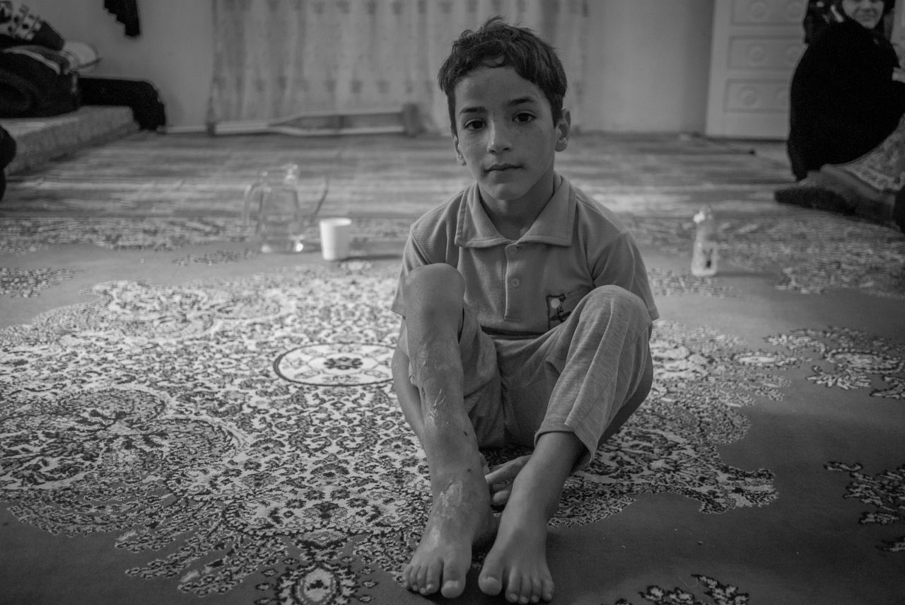 4-year-old Mohammed crossed into Jordan from Syria with two broken legs, a fractured skull, two broken arms and a smashed pelvis after his home caved in during intensive shelling.