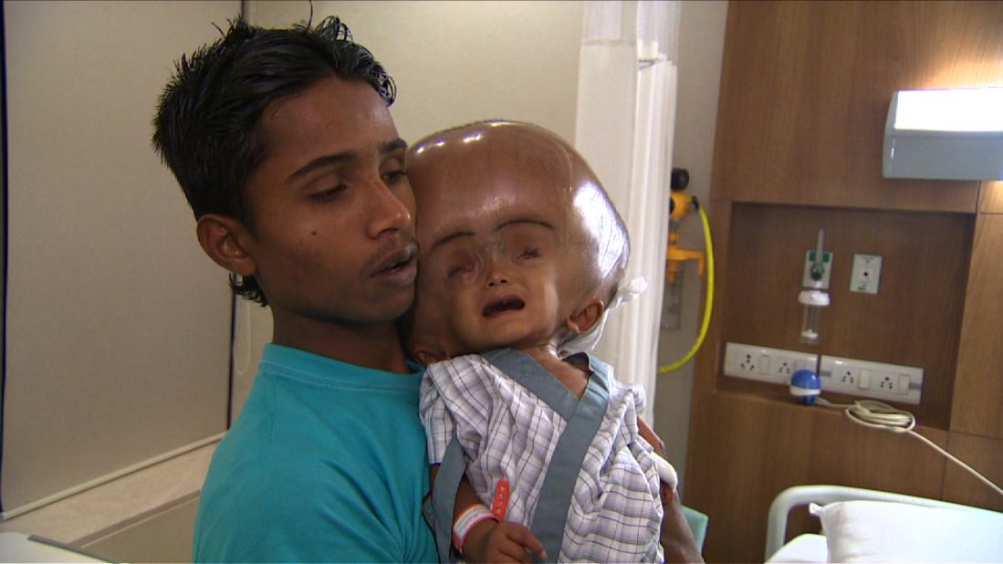 Indian child Roona Begum recovering after hydrocephalus surgery | CNN