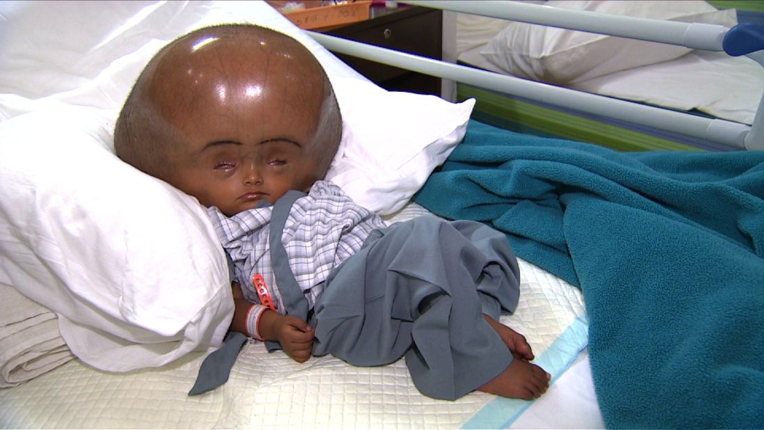 Four months ago, the circumference of Roona Begum's head was 94 centimeters -- almost triple the size of a normal baby -- due to ten liters of excess fluid inside her brain. Born in a remote village in northeastern India, Roona was diagnosed with an extreme form of hydrocephalus and was given only a few months to live.