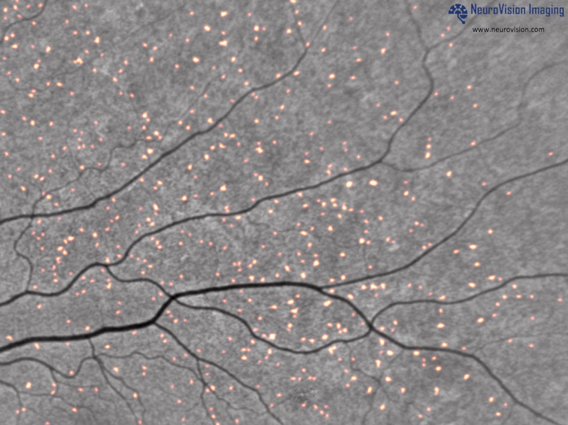 This image from NeuroVision Imaging shows beta-amyloid plaques, highlighted in red, inside the retina.