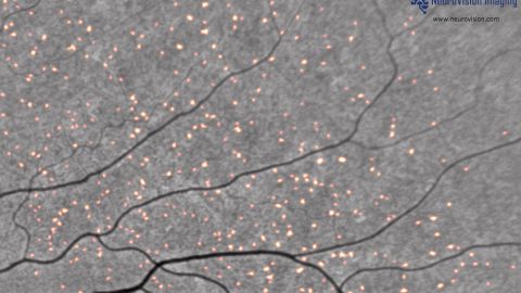 This image from NeuroVision Imaging shows beta-amyloid plaques, highlighted in red, inside the retina.